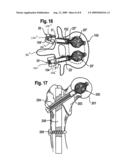 IMPLANT FOR STABILIZING VERTEBRAE OR BONES diagram and image