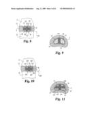 Intervertebral Disc Nucleus Implants and Methods diagram and image