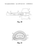 Intervertebral Disc Nucleus Implants and Methods diagram and image