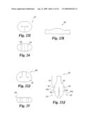 Intervertebral Disc Nucleus Implants and Methods diagram and image