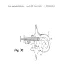 Intervertebral Disc Nucleus Implants and Methods diagram and image