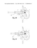 Intervertebral Disc Nucleus Implants and Methods diagram and image