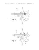 Intervertebral Disc Nucleus Implants and Methods diagram and image