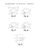 Intervertebral Disc Nucleus Implants and Methods diagram and image