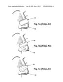 APPARATUS AND METHOD FOR IMPROVING NASAL BREATHING diagram and image