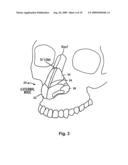 APPARATUS AND METHOD FOR IMPROVING NASAL BREATHING diagram and image