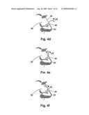 APPARATUS AND METHOD FOR IMPROVING NASAL BREATHING diagram and image