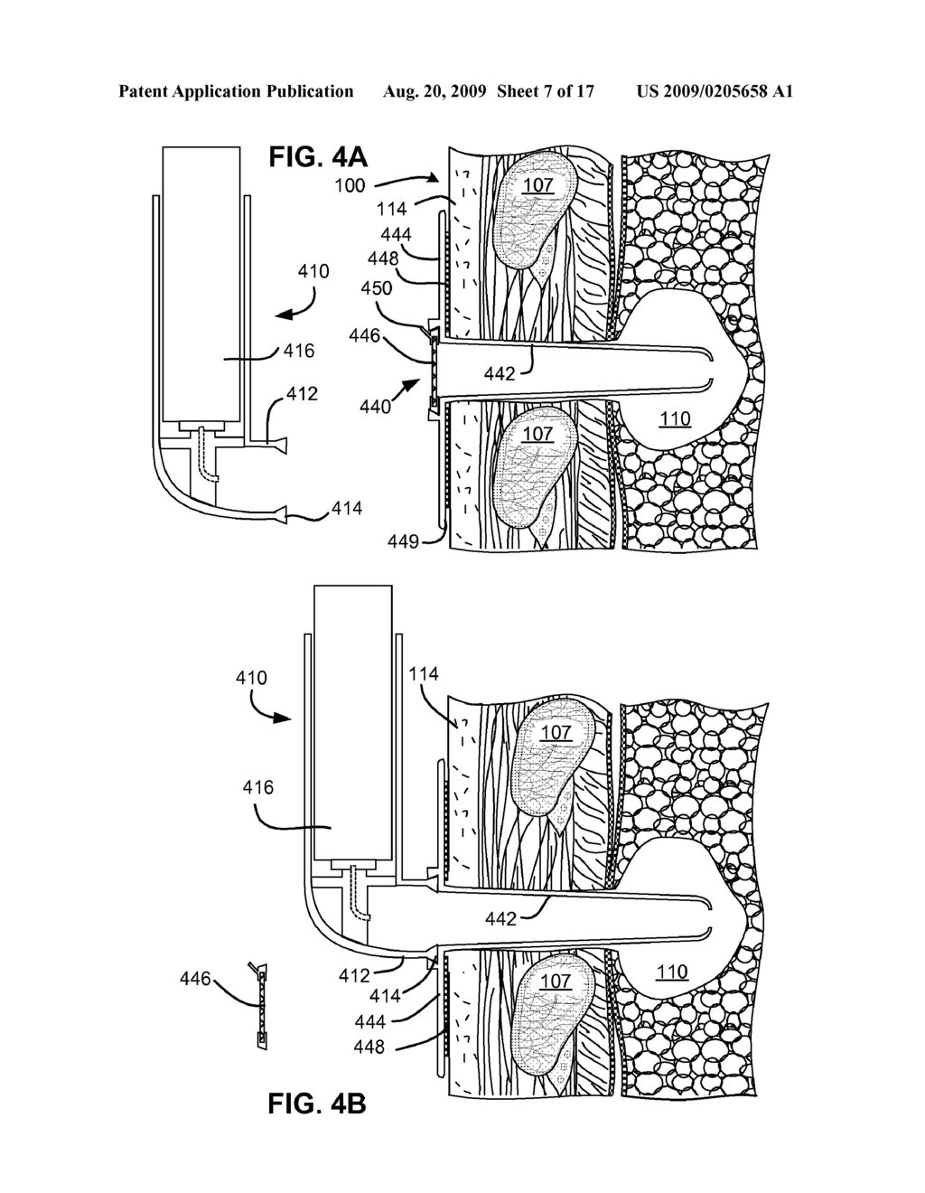 DEVICES AND METHODS FOR DELIVERY OF A THERAPEUTIC AGENT THROUGH A PNEUMOSTOMA - diagram, schematic, and image 08