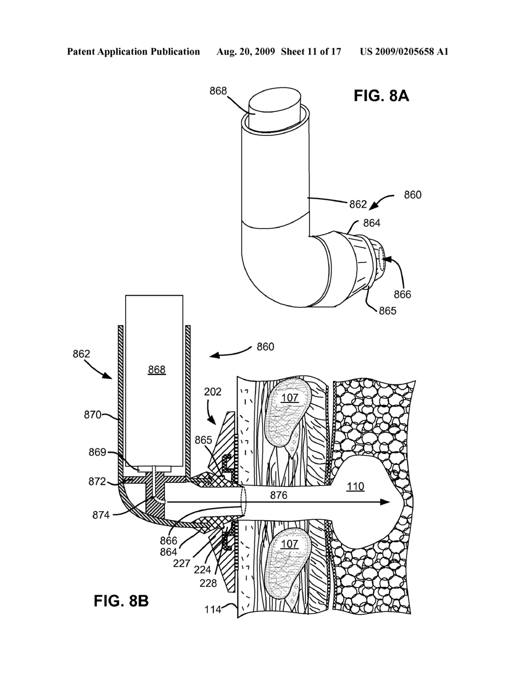 DEVICES AND METHODS FOR DELIVERY OF A THERAPEUTIC AGENT THROUGH A PNEUMOSTOMA - diagram, schematic, and image 12