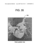 METHOD FOR GENERATING A REGISTERED IMAGE RELATIVE TO A CARDIAC CYCLE AND A RESPIRATORY CYCLE OF A PERSON diagram and image