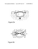 IMPLANTABLE TRANSDUCER diagram and image