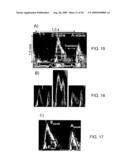 PRESSURE RECOVERY INDEX TO ASSESS CARDIAC FUNCTION diagram and image