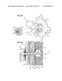 ASPIRATOR AND METHOD FOR PNEUMOSTOMA MANAGEMENT diagram and image