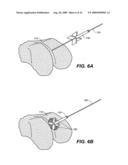 DEVICE AND METHOD FOR ALLOGRAFT AND TISSUE ENGINEERED OSTEOCHONDRAL GRAFT SURFACE MATCHING, PREPARATION, AND IMPLANTATION diagram and image