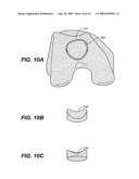 DEVICE AND METHOD FOR ALLOGRAFT AND TISSUE ENGINEERED OSTEOCHONDRAL GRAFT SURFACE MATCHING, PREPARATION, AND IMPLANTATION diagram and image