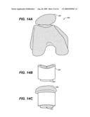 DEVICE AND METHOD FOR ALLOGRAFT AND TISSUE ENGINEERED OSTEOCHONDRAL GRAFT SURFACE MATCHING, PREPARATION, AND IMPLANTATION diagram and image