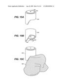 DEVICE AND METHOD FOR ALLOGRAFT AND TISSUE ENGINEERED OSTEOCHONDRAL GRAFT SURFACE MATCHING, PREPARATION, AND IMPLANTATION diagram and image