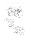 Ventilation Device and Insertion System Therefor diagram and image