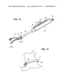 Devices, Tools and Methods for Atrial Appendage Exclusion diagram and image