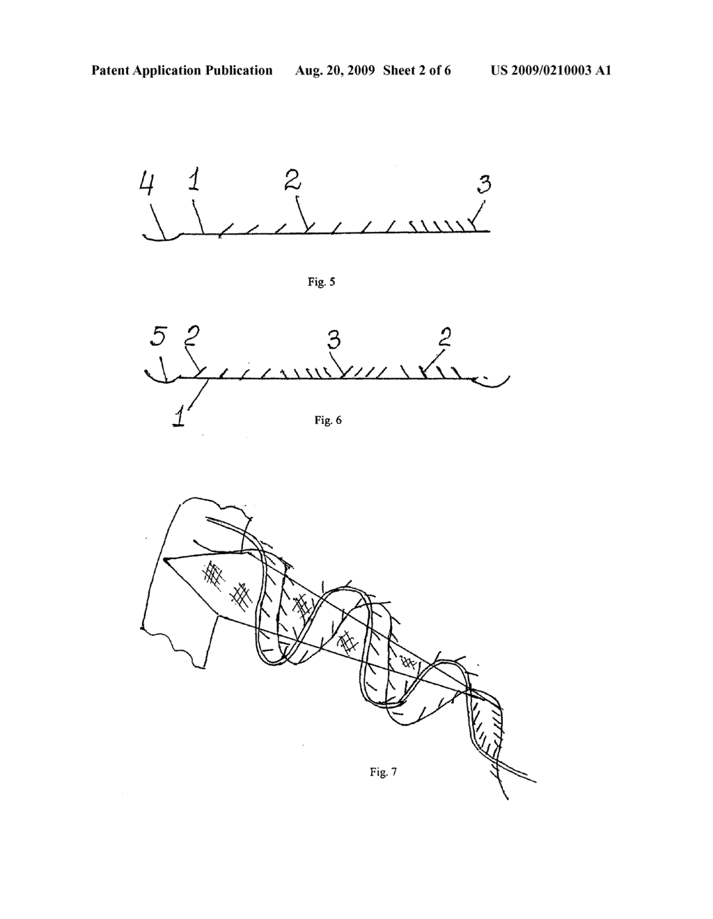 SURGICAL SUTURE MATERIAL AND METHOD FOR THE APPLICATION THEREOF - diagram, schematic, and image 03