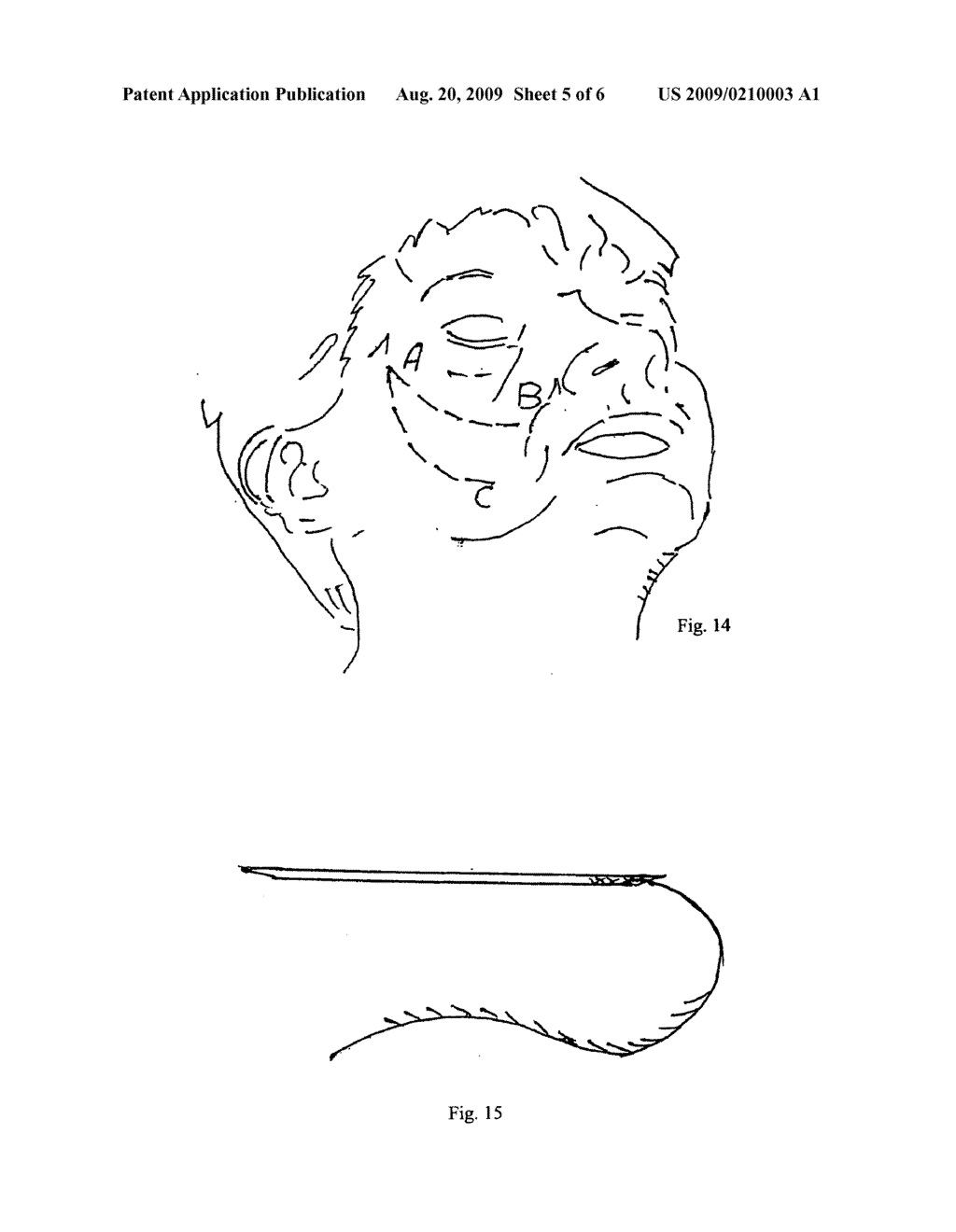 SURGICAL SUTURE MATERIAL AND METHOD FOR THE APPLICATION THEREOF - diagram, schematic, and image 06