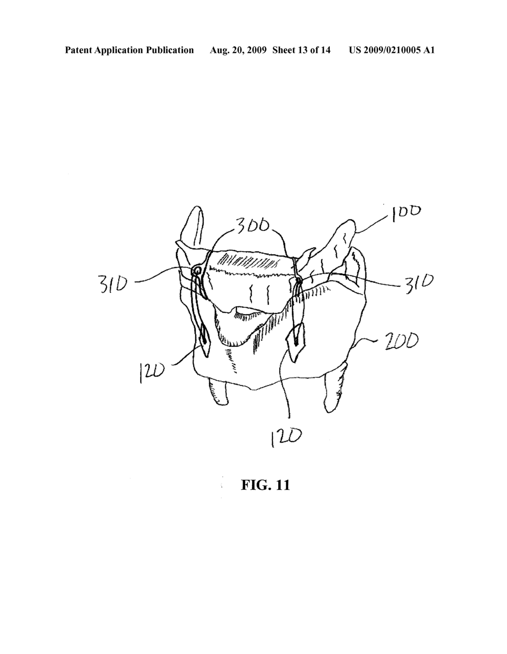 METHOD AND SYSTEM FOR DISPLACING HYOID BONE - diagram, schematic, and image 14