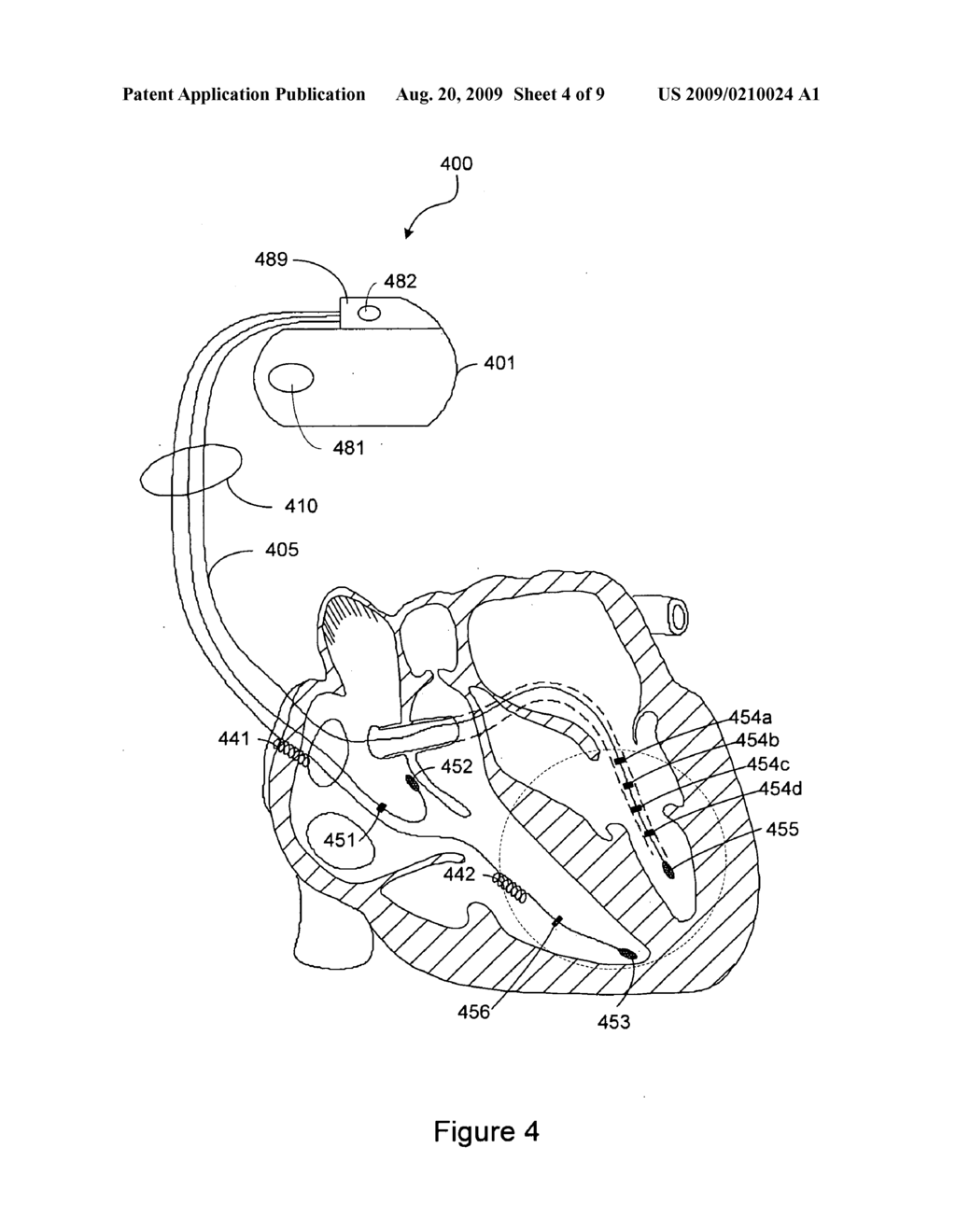 Method and Apparatus for Phrenic Stimulation Detection - diagram, schematic, and image 05