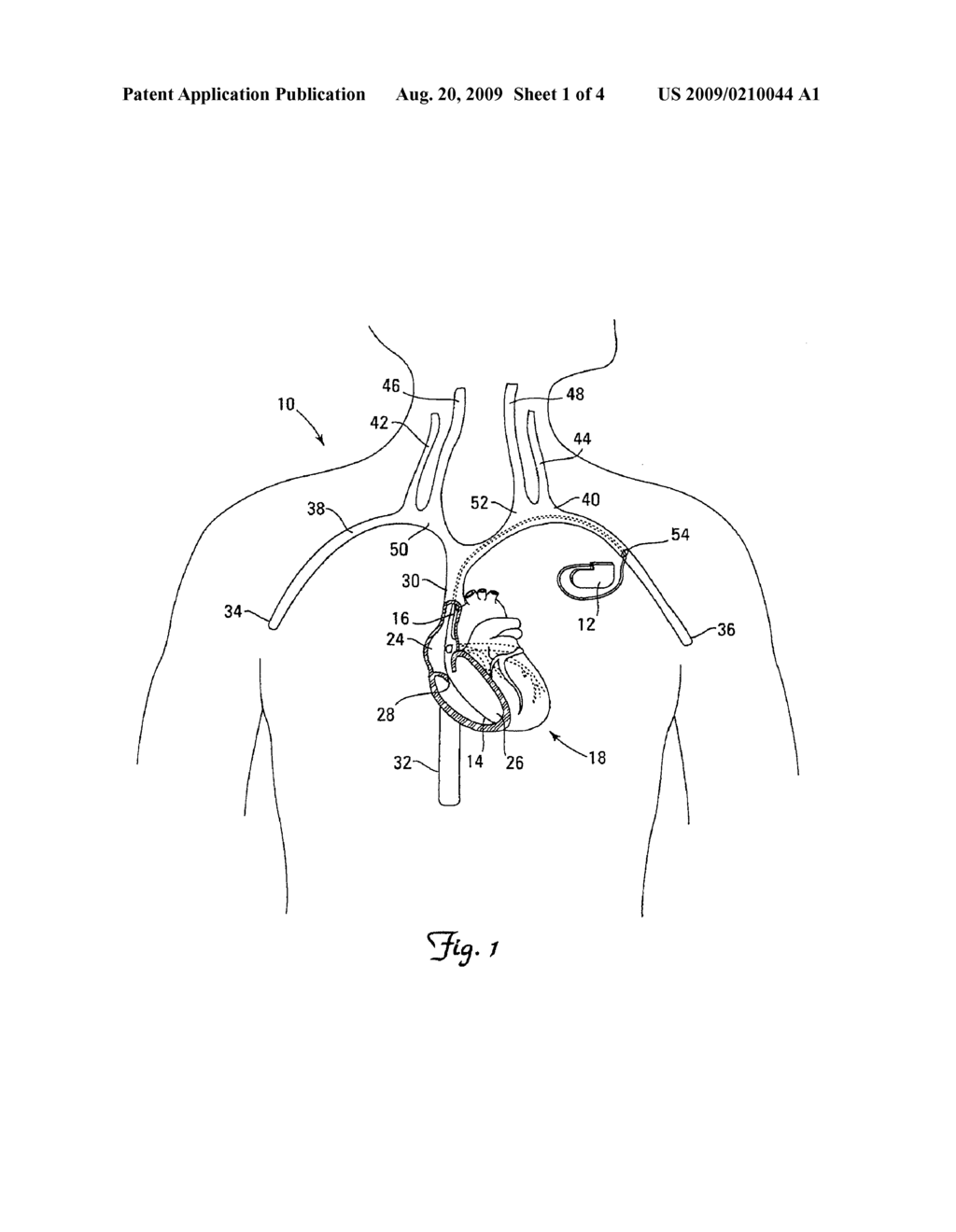 MODULAR, ZONE-SPECIFIC MEDICAL ELECTRICAL LEAD DESIGN - diagram, schematic, and image 02