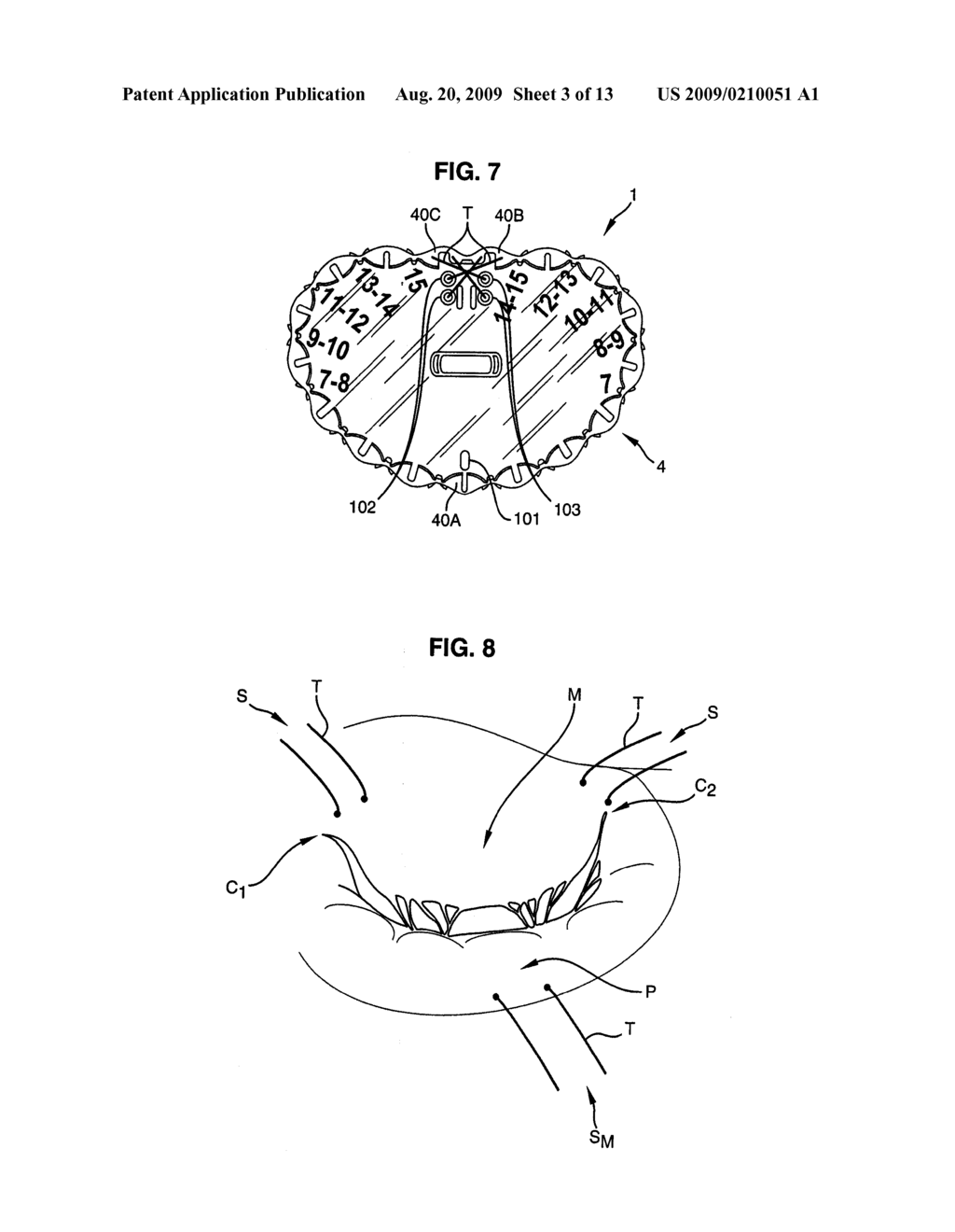 UNIVERSAL ANNULOPLASTY SYSTEM - diagram, schematic, and image 04