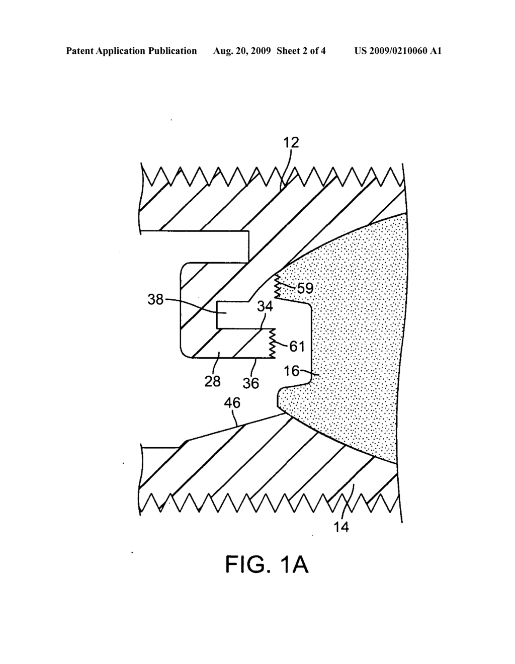 Intervertebral Prosthetic Disc With Metallic Core - diagram, schematic, and image 03