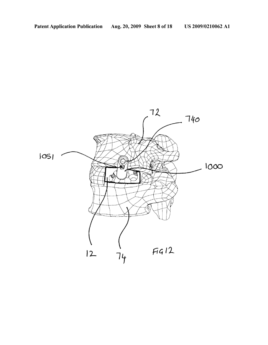 Orthopaedic Implants and Prostheses - diagram, schematic, and image 09