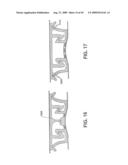 Closure Device Providing Visual Confirmation of Occlusion diagram and image