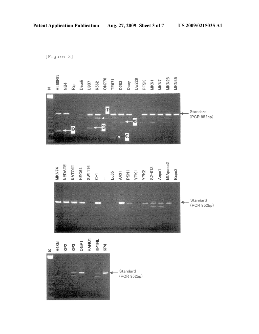 METHOD OF ASSESSING CANCEROUS CONDITIONS AND REAGENT FOR DETECTING GENE PRODUCT TO BE USED IN THE METHOD - diagram, schematic, and image 04