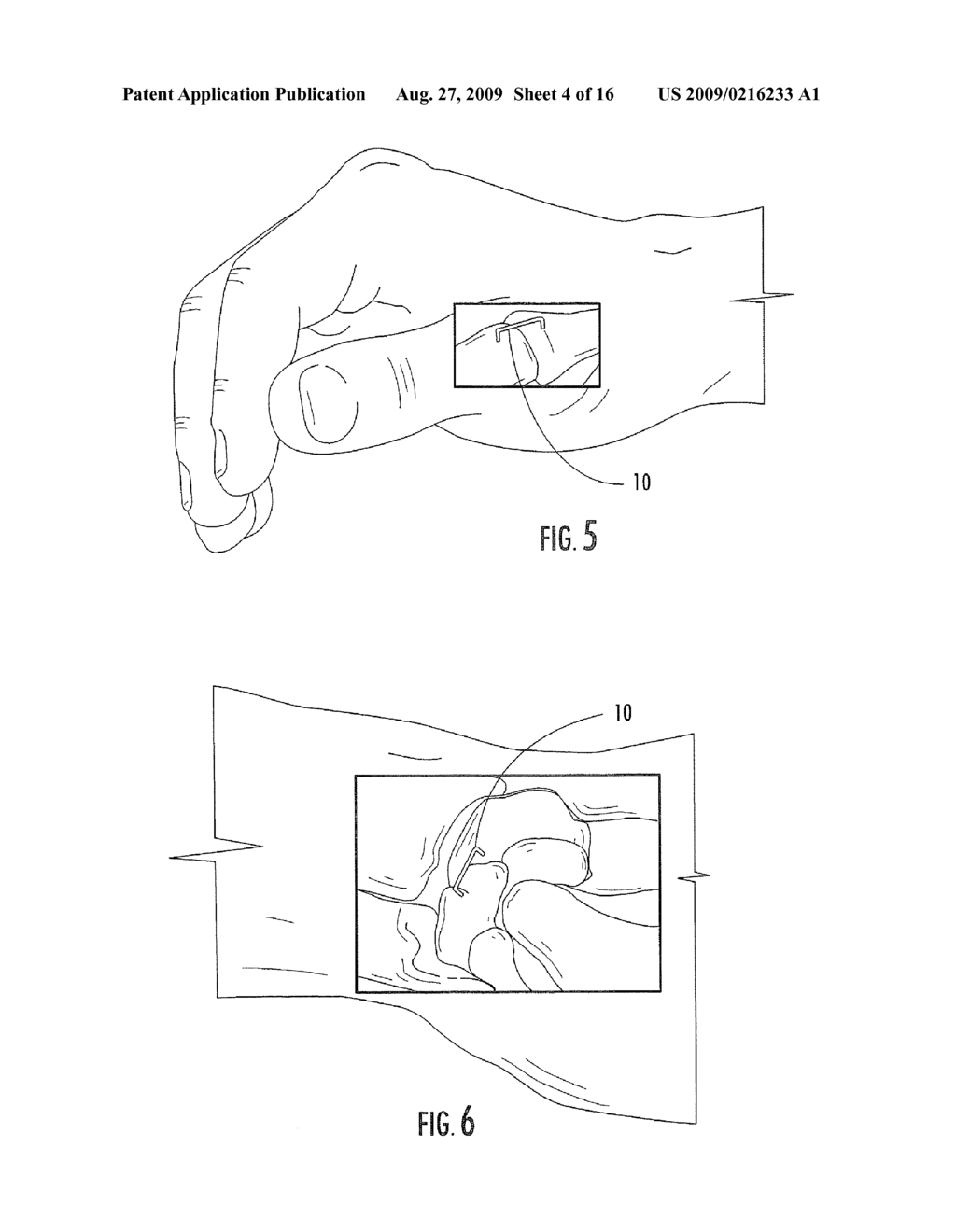 BIOSTAPLES SUITABLE FOR WRIST, HAND AND OTHER LIGAMENT REPLACEMENTS OR REPAIRS - diagram, schematic, and image 05