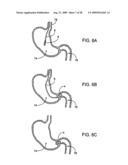 GASTRIC RETAINING DEVICES AND METHODS diagram and image