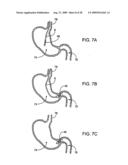 GASTRIC RETAINING DEVICES AND METHODS diagram and image