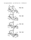 GASTRIC RETAINING DEVICES AND METHODS diagram and image