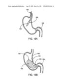 GASTRIC RETAINING DEVICES AND METHODS diagram and image