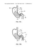 GASTRIC RETAINING DEVICES AND METHODS diagram and image