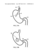 GASTRIC RETAINING DEVICES AND METHODS diagram and image