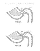 GASTRIC RETAINING DEVICES AND METHODS diagram and image