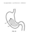 GASTRIC RETAINING DEVICES AND METHODS diagram and image