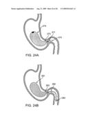 GASTRIC RETAINING DEVICES AND METHODS diagram and image