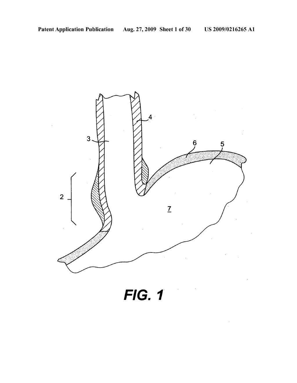 Tissue fasteners and related deployment systems and methods - diagram, schematic, and image 02