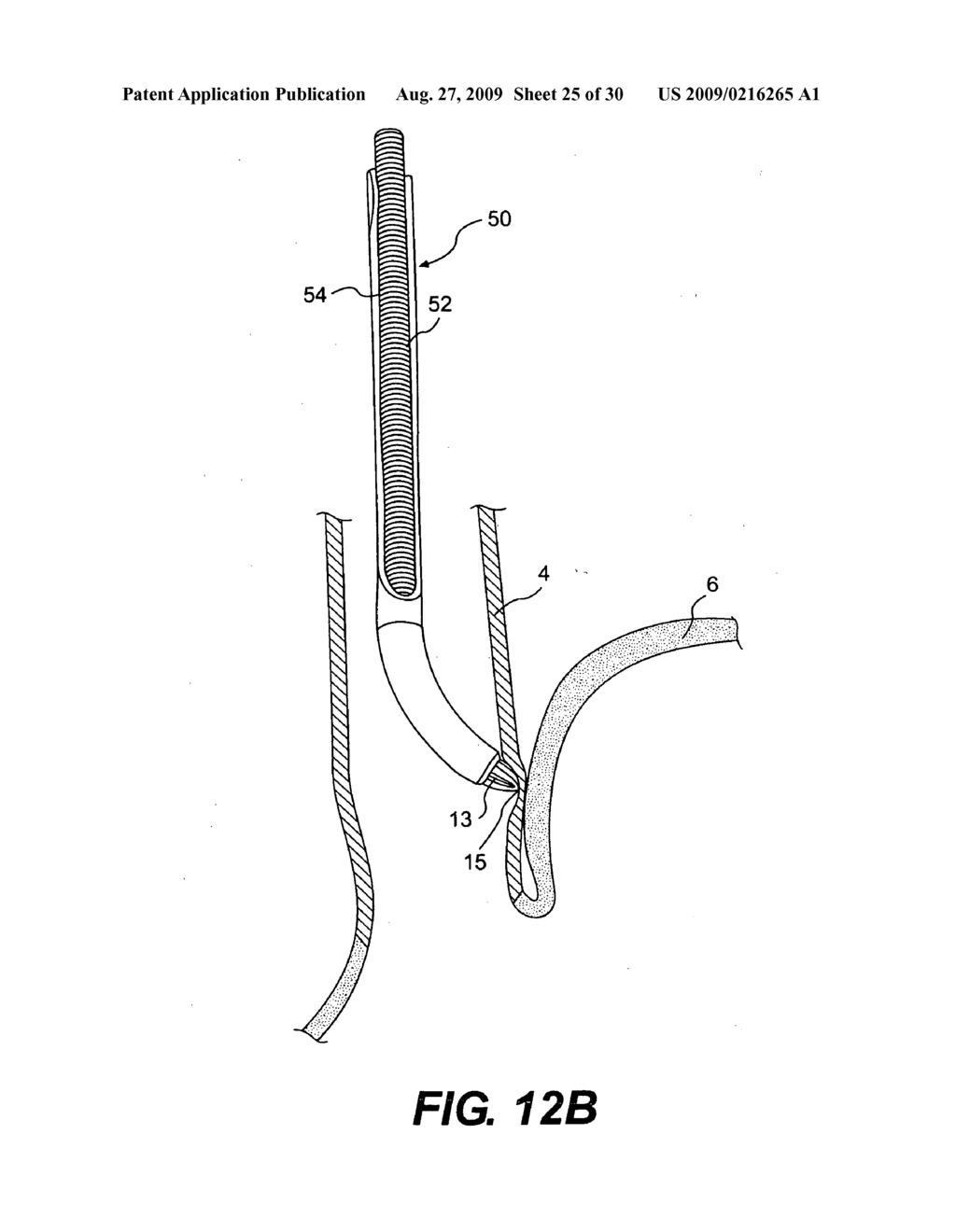 Tissue fasteners and related deployment systems and methods - diagram, schematic, and image 26