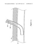CLOSURE DEVICE WITH RAPIDLY DISSOLVING ANCHOR diagram and image