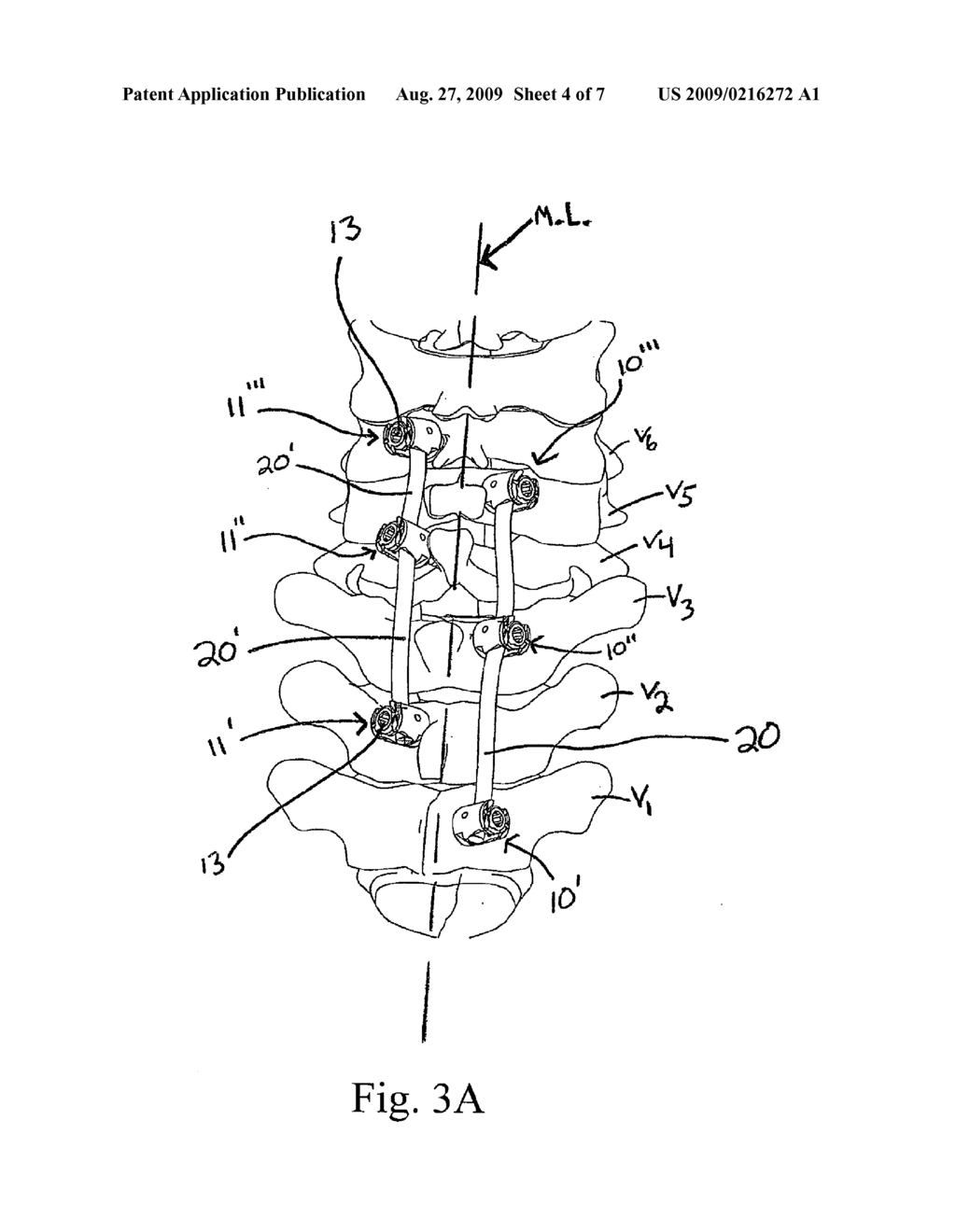 METHOD AND SYSTEM FOR TRANS-LAMINA SPINAL FIXATION - diagram, schematic, and image 05