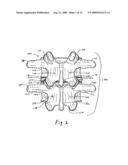 FACET JOINT PROSTHESIS diagram and image