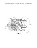 FACET JOINT PROSTHESIS diagram and image