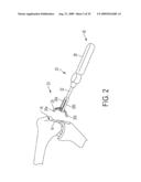 Bone Resurfacing System and Method diagram and image